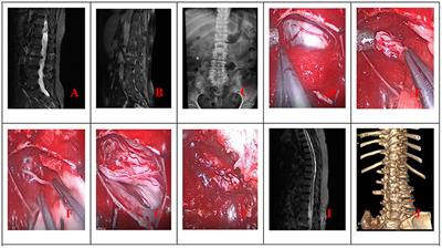 Comparison of Neuroendoscopic and Microscopic Surgery for Unilateral Hemilaminectomy: Experience of a Single Institution